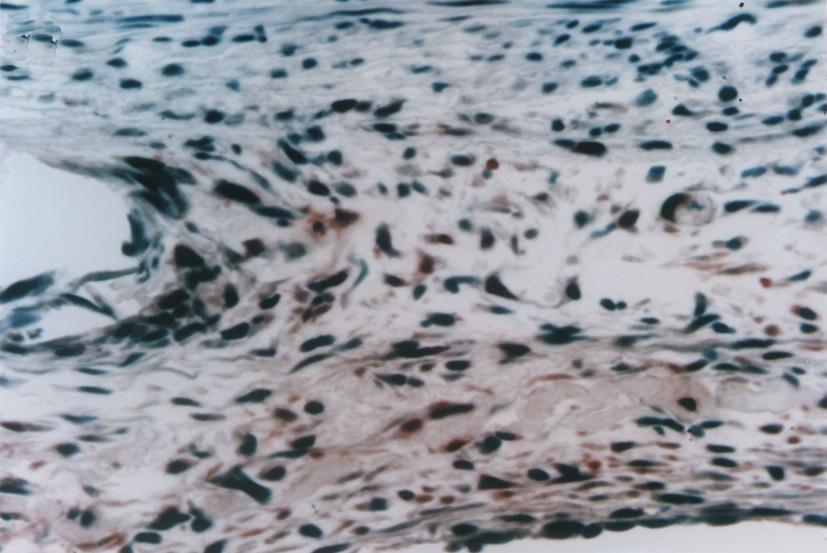 Fig. 6. Immunohistochemical staining for PCN. Positive cells are stained as a brown color. High PCN index is shown in the neointima of a stented porcine coronary artery at 14 days after stenting ().