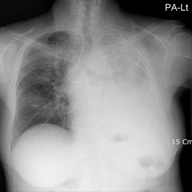 Tuberculosis and Respiratory Diseases Vol. 62. No.2, Feb. 2007 Figure 1. (A) Chest X-ray on day 25 of gefitinib therapy. Poorly defined ground glass opacities in right upper lung field has developed.