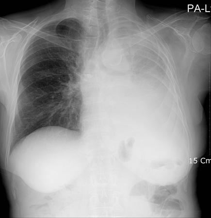 HJ Lee et al: Gefitinib-related interstitial pneumonia Figure 2. Chest X-ray 1 week after the discontinuation of gefitinib and steroid treatment. Ground glass opacity of right lung has improved.