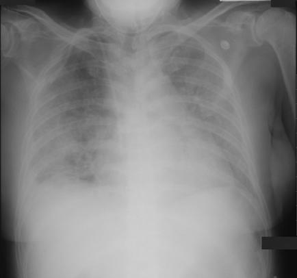 Tuberculosis and Respiratory Diseases Vol. 62. No.2, Feb. 2007 복용은중단하였고 methylprednisolone (125mg/day) 과광범위항생제인 ceftazidime 과 amikacin 을투여하였다.