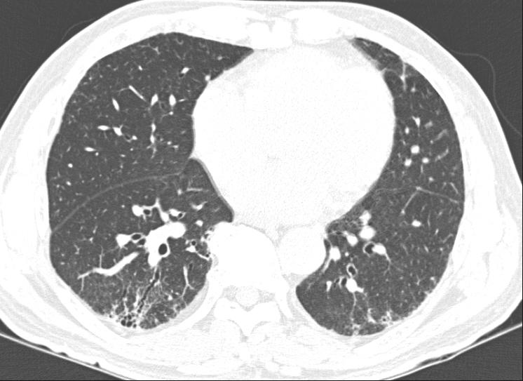 Yu-Whan Oh. Radiologic approach to the idiopathic interstitial pneumonias A B C D Figure 2. A 66-year-old man with IPF with progression over 4 years.