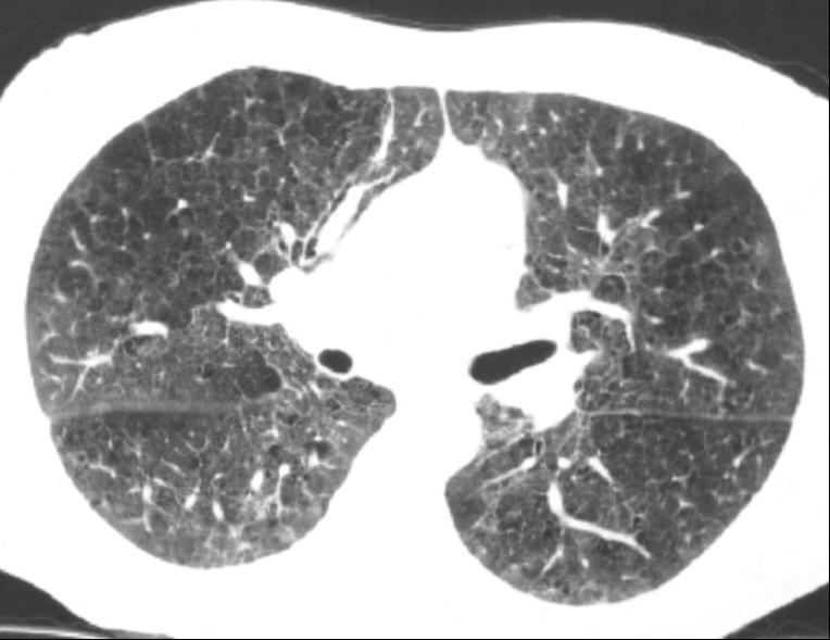 pneumonia, DIP)은 흡연과 관련된 동종의 폐질환 군에 속하면서 중증도가 서로 다른 질환들로 볼 수 있다[30]. RB는 특별한 증상이 없는 흡연자들에게서 우연히 발견되는 조직학적 이상 소견을 지칭한다.