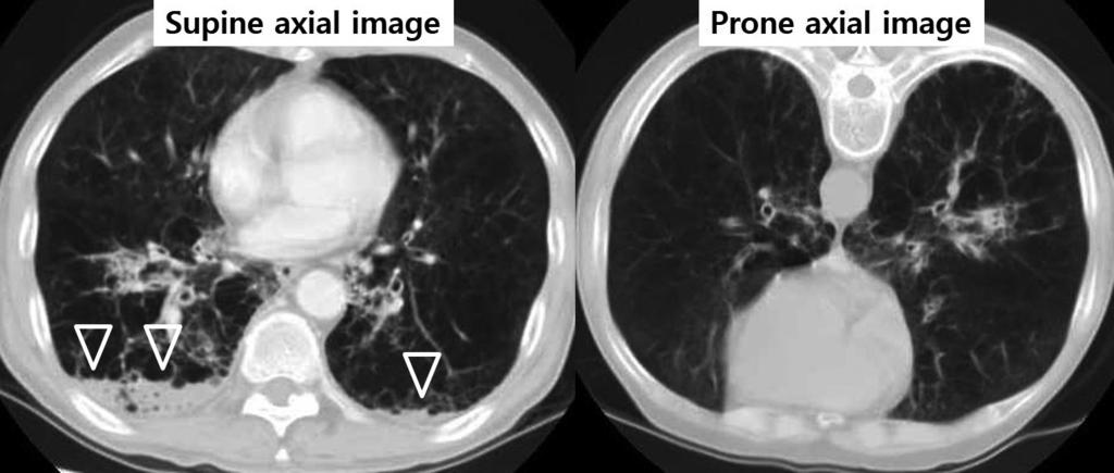 Fig. 5. Pneumonia with underlying emphysema in a 63-year-old man. Supine axial image shows fluid levels (arrowheads) in the dependent portion of both lower lobes.