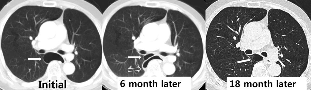 Initial CT image shows a bulla (arrow) at the right azygoesophageal recess.