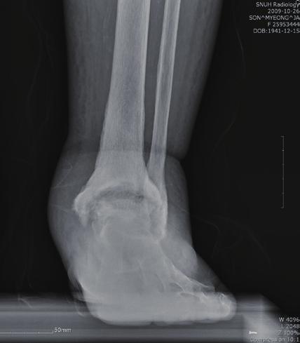 cm 이이상적이다. 이보다짧으면짧은하퇴절단이라고하는데, 하퇴의지를착용하기위해서는최소한 3~5 cm 의절단단이필요하다. (7) 대퇴절단 (Transfemoral Amputation, Above Knee Amputation) (Fig.