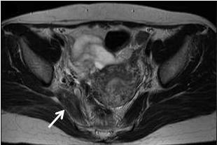 A C B Figure 1. Pelvis MRI of the patient.
