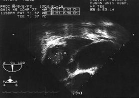 -Sun-Mi Lee, et al : A case of tricuspid valve infective endocarditis following Lemierre syndrome - Figure 2. Transesophageal echocardiography demonstrates 2.49 2.