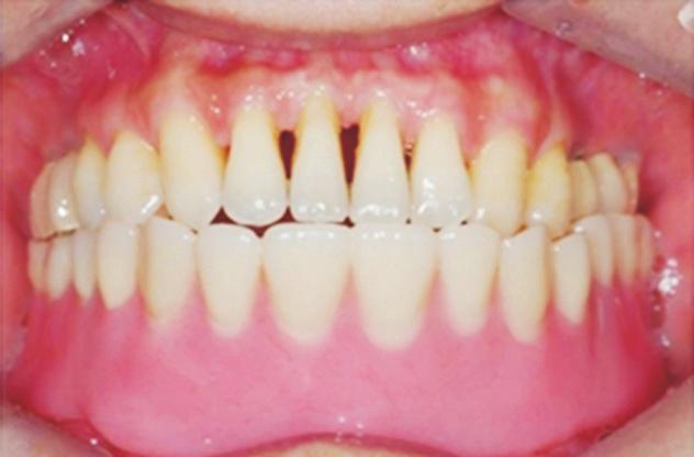 Case Report Fig. 3. () Implant ball attachment. () Overdenture. 부위를없앤납의치시적을통해고정성보철물을원하는환자에게고정성보철물수복으로인한안면지지의부족을미리보여줄수있다고설명한바있다. 환자는납의치시적을통해안면및상순지지의부족을보였다.