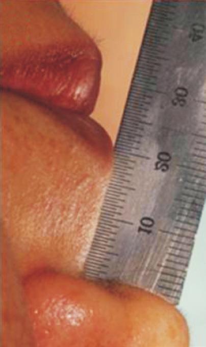 (26~30 mm), average (21~25 mm) Cited from the article of Zitzmann et