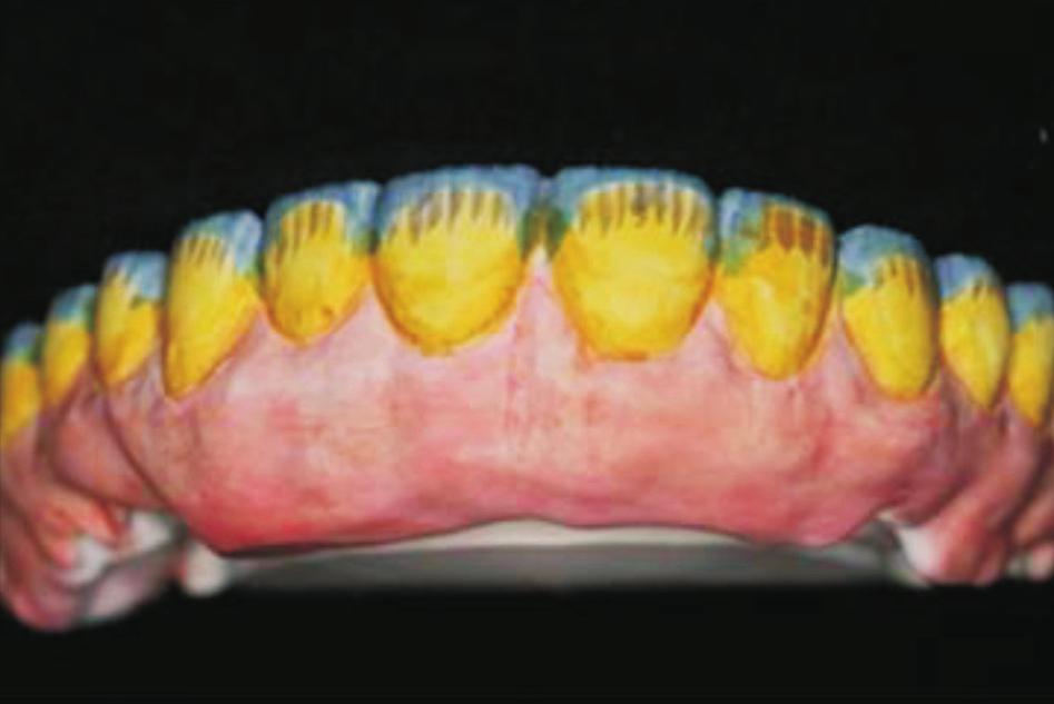 기 존의치의치은, 치아형태및배열을복제하기위해실리콘인덱스를사용하였고, 구강내에서악간관계채득후최종모형단계에서아크릴릭레진 (Luxatemp utomix
