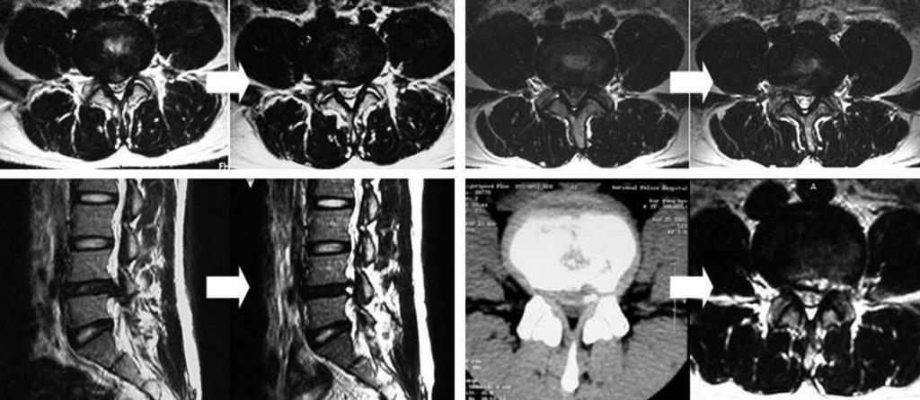 요추부내시경절제술의접근법 안영준외 Fig. 6. Radiologic changes at preoperative and postoperative 1 month after PELD. (A) Posterolateral disc herniation. (B) Central huge disc herniation.