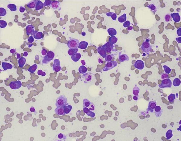 함지연 외: Immunoglobulin Isotype Switching in a Plasma Cell Myeloma Patient 과정 혹은 독립적인 여러 악성 클론의 증식이 만드는 현상 등의 여 globulin 검사는 시행하지 않았다. 이후 환자는 항암화학요법으로 러 가설이 여전히 존재한다[5].