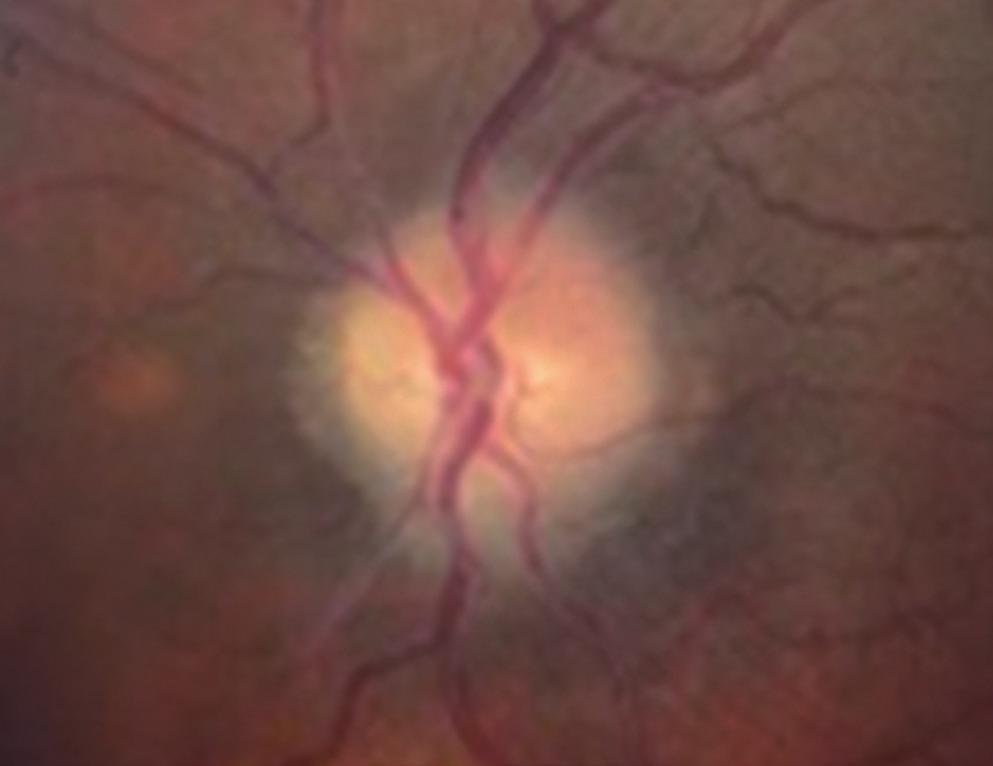 Grade IV papilledema is characterized by loss of major vessels on the disc.
