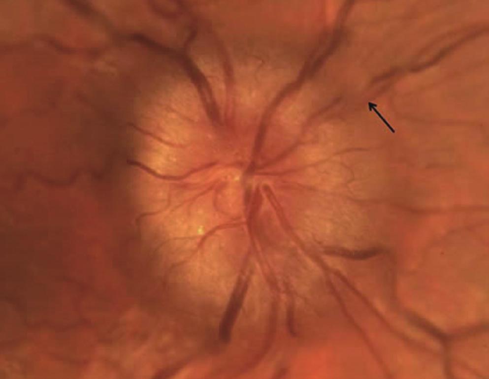 6), 시신경형성부전 (optic nerve hypoplasia), 밀집된원시성유두 (crowded hyperopic disc), 시신경유두과오종 (optic disc hamartoma), 말이집신경섬유 (myelinated nerve fiber) 등도포함된다.