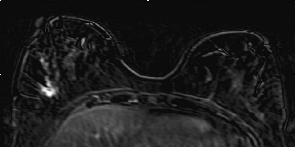 Subtraction MRI image shows linear ductal enhancement extending from main tumor at right breast.