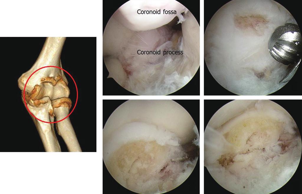 Jae-Sung Lee. Surgical Treatment of the Primary Osteoarthritis of the Elbow: Open vs. rthroscopy C D Fig. 2. nterior compartment.