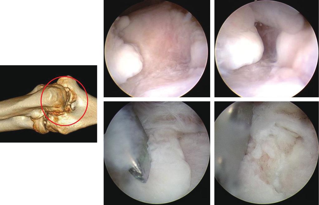 (C) remained osteophyte of the coronoid tip is removed using the microfracture instrument or small osteotome. (D) Coronoid tip after fully resecting osteophyte. C D Fig. 3. Posterior compartment.