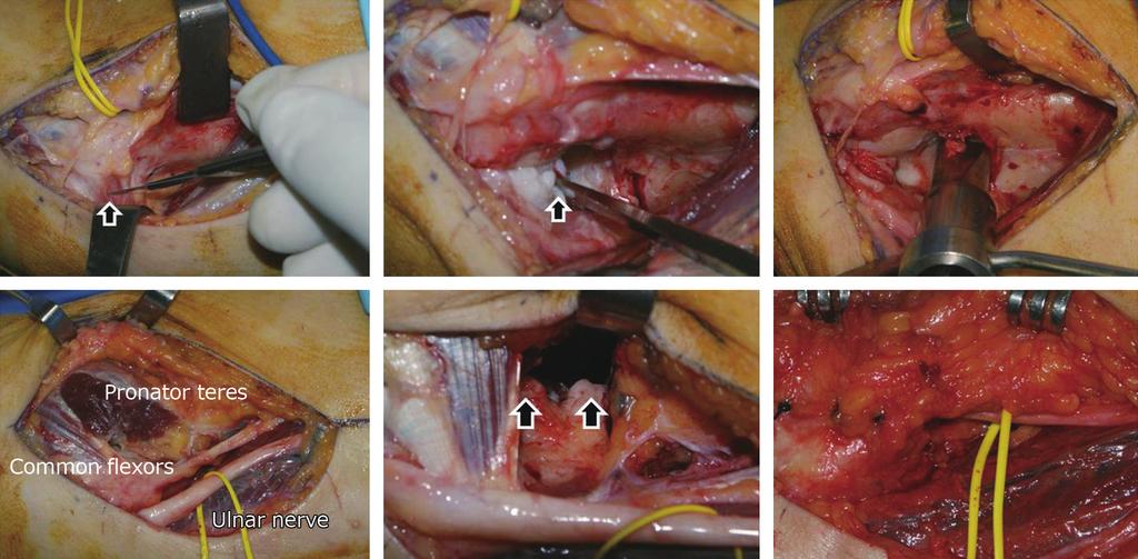 Jae-Sung Lee. Surgical Treatment of the Primary Osteoarthritis of the Elbow: Open vs.
