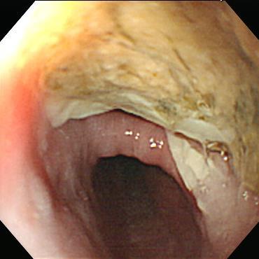 large out-pouching lesion with food