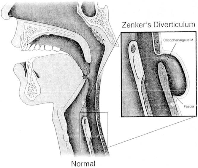 Anatomy of ZD The neck of the diverticulum originates between the fibers of the inferior constrictor muscle and