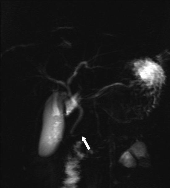 (arrow). A B Fig. 3. Magnetic resonance cholangiopancreatography (MRCP). A. T2-weighted image shows normal pancreatic duct in pancreas head. B. In maximum intensity projection image, pancreatic duct of body and tail and Santorini duct cannot be seen.