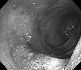 (B) A colonoscopy shows severe erythema with several superficial ulcers at the terminal ileum. Figure 4. Pathological findings.
