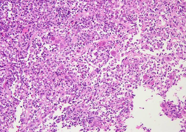 (B) It is positive for CMV immunohistochemical staining (Immunohistochemical stain, 400). Figure 4. Photographic findings.