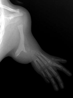 This case can be classified as type C by Tytherleigh-Strong and Hooper and proximal ulnar longitudinal dysplasia by Goldfarb et