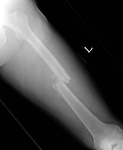 (B) Antero-posterior and lateral radiographs of the femur after the operation show intramedullary nailing fixation.