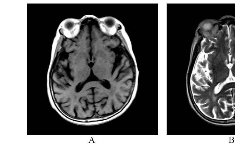 비케톤성당뇨병으로유발된고혈당성무도증의한 양방복합치료증례보고 (433) Fig. 1. Brain MRI (A) T1-Weighted image of basal ganglia(bg) and striatum. Old lacunar infarctions of both BG are seen. (B) T2-Weighted image of BG and striatum.