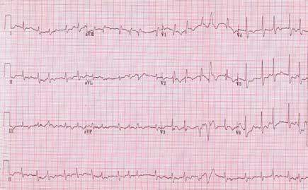SE Oh et al: A case of pulmonary thromboembolism in a patient with hyperhomocysteinemia Figure 1. EKG showing atrial fibrillation, T-wave inversion at lead III and incomplete RBBB. Figure 3.