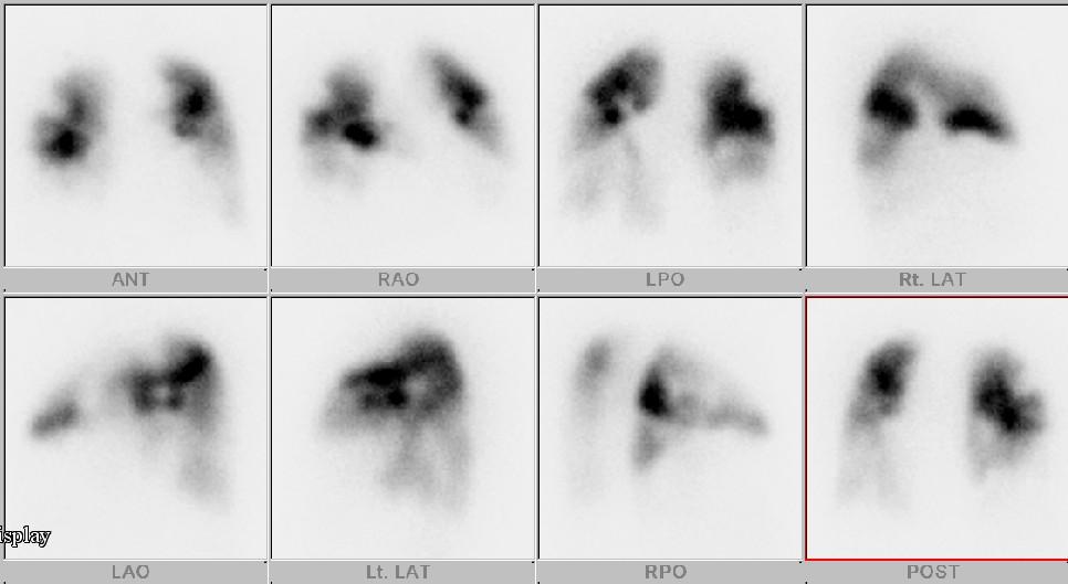 Tuberculosis and Respiratory Diseases Vol. 62. No.3, Mar. 2007 Figure 4. Lung perfusion scan shows moderate photon defect in both lower lobes.