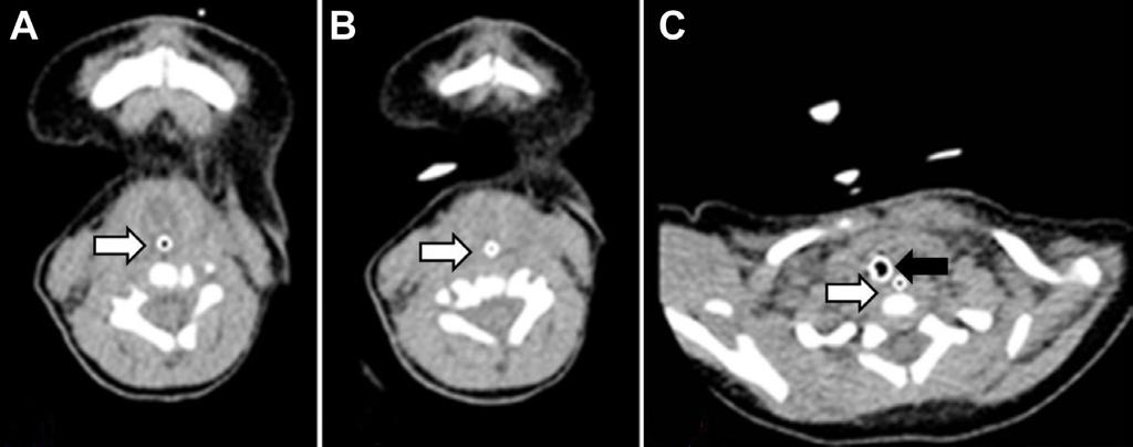 Do HJ, et al. Successful treatment of tracheal agenesis 영상학적소견 : 환아는동반된다른기형을확인하기위하여심초음파, 뇌자기공명영상 (magnetic resonance imaging), 흉부조영증강컴퓨터단층촬영 (chest enhanced computed tomography) 을시행하였다.