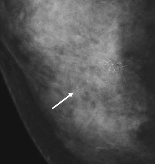 (CC) view. Figure 3. n interval cancer due to underestimation of calcifications.