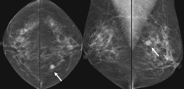 Initial bilateral craniocaudal and MLO mammograms () show subtle small density