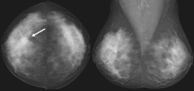 Subsequent screening mammograms a year later () clearly show an illdefined mass