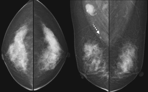 abnormality in breast.