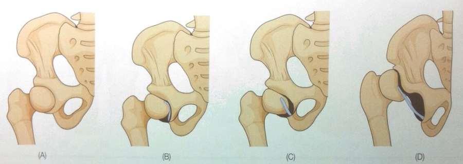 4-1) 고관절이형성증 그림 13-11> 고관절이형성증 [DDH] (A) 정상 (B) 관골구형성부전 (C) 아탈구 (D) 탈구 (B)