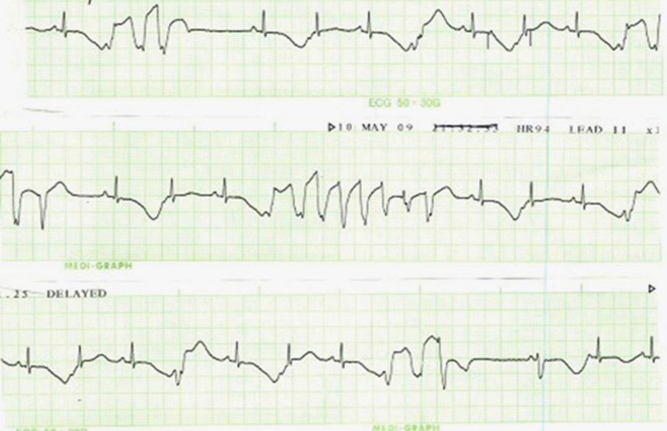 Electrocardiogram during the use of levofloxacin.