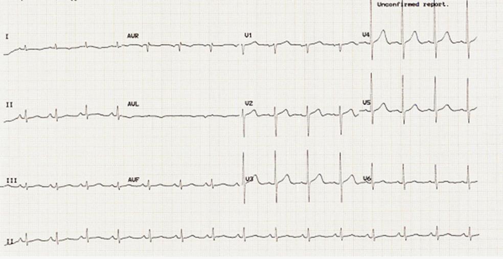 Electrocardiogram after withdrawal of levofloxacin. Normal sinus rhythm was returned.