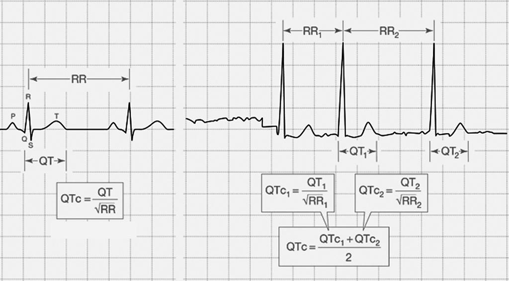 Tuberculosis and Respiratory Diseases Vol. 69. No. 6, Dec. 2010 Figure 8. Measuring of the corrected QT interval by Bazett formula (left, normal sinus rhythm; right, atrial fibrillation). 참고문헌 1.