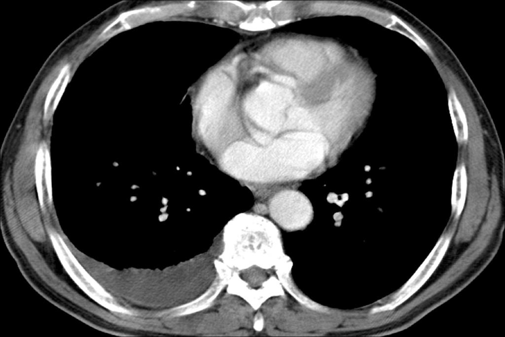 lobe. Multiple nodules are scattered in the upper lung zone of both lungs.