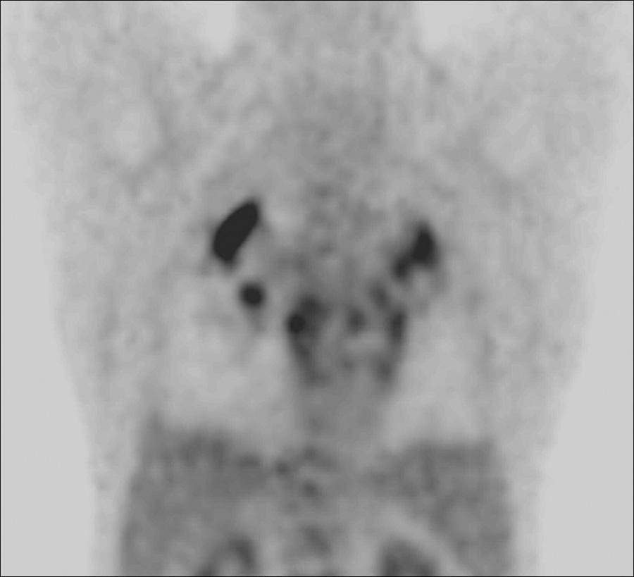 Pneumoconiosis with progressive massive fibrosis in a 61-year-old male. A.