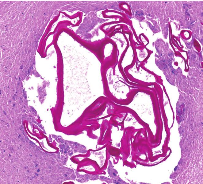 We could approach this unusual hepatic mass, mimicking clinical features of malignancy after consultation to Professor Jong-Yil Chai, Department of Parasitology and Tropical Medicine, Seoul National