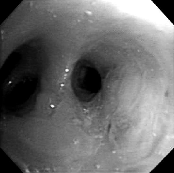 Tuberculosis and Respiratory Diseases Vol. 67. No. 2, Aug. 2009 Figure 4. (A) On the 9th hospital day, follow-up chest radiography shows improved lesion.