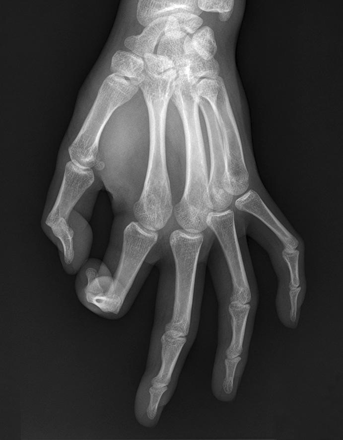 (A) Pre-operative true antero-posterior radiograph of the involved right hand of