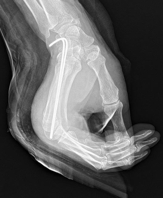 (E, F) One-year postoperatively taken radiograph showed that complete bony union was achieved with acceptable alignment. Table 3.