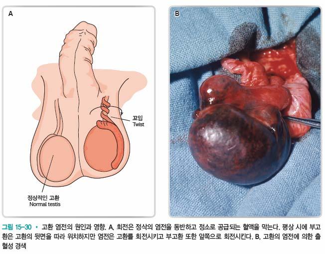 고환염전 남성생식기계질환 (5)