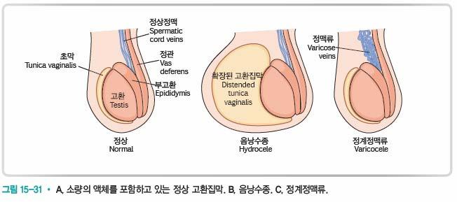 음낭수종 남성생식기계질환 (6) 고환집막에다량의액체가축적된경우 정계정맥류