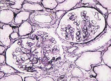 170 박문향 A B Fig. 3. Lupus nephritis class V and III (A). Note segmental endocapillary proliferation and diffuse thickening of glomerular capillary walls with spikes (methenamine silver). Fig. 4.
